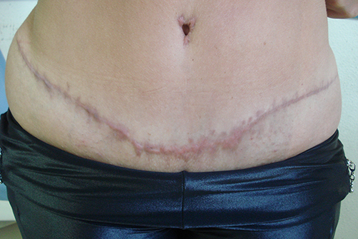 Abdominoplastia-001