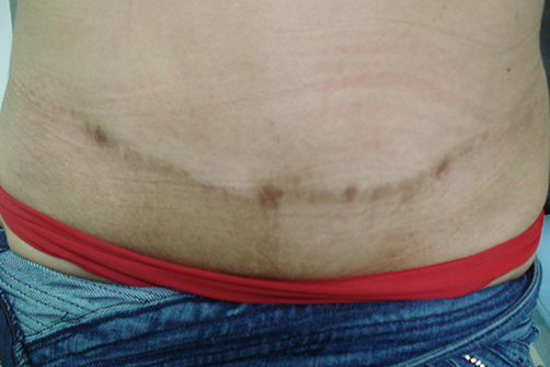 Abdominoplastia-009