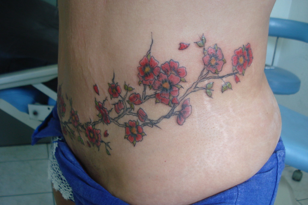 Abdominoplastia-014