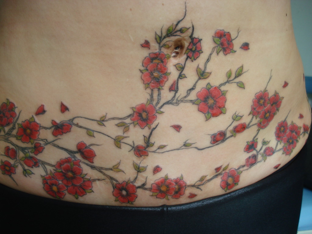 Abdominoplastia-017