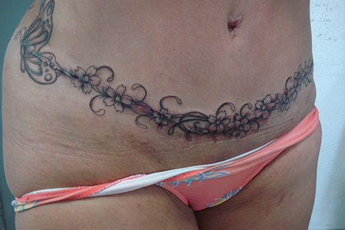 tatuagem-estetica-003