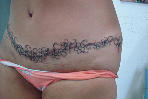 tatuagem-estetica-004